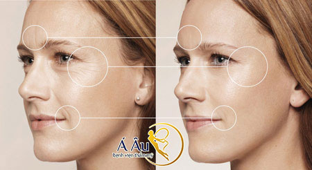 Hình ảnh Chỉ với 1 lần thực hiện duy nhất, phương pháp căng da mặt bằng chỉ vàng 24k sẽ giúp bạn trẻ hóa gương mặt toàn diện.