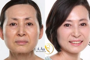 Nhờ liệu pháp căng da mặt bằng chỉ S Soft, khuôn mặt chị em đã có những thay đổi đáng ngạc nhiên.
