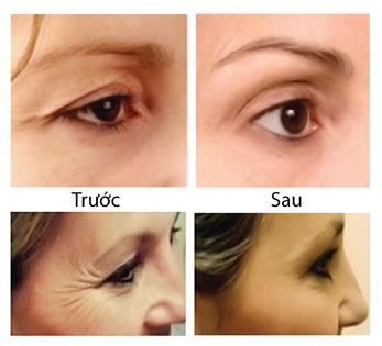 Hình ảnh sau khi thực hiện căng da bị nhăn tại vùng mắt ở bệnh viện thẩm mỹ Á Âu 