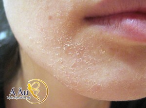 Da mặt bị khô và nứt nẻ là hiện tượng đầu tiên của tình trạng lão hóa da.