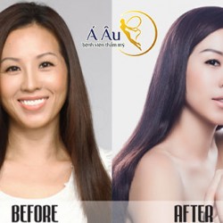 Gương mặt chị em sẽ được cải thiện đáng kể nhờ phương pháp căng da toàn diện.